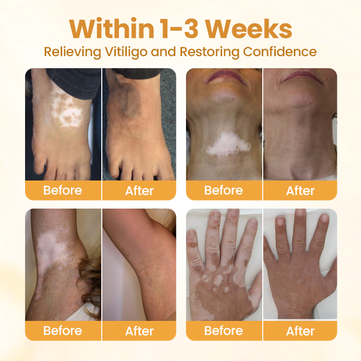 ⏰Last Day Promotion: 60% OFF🔥Cvreoz® VitiliGo Bee Toxin Cream