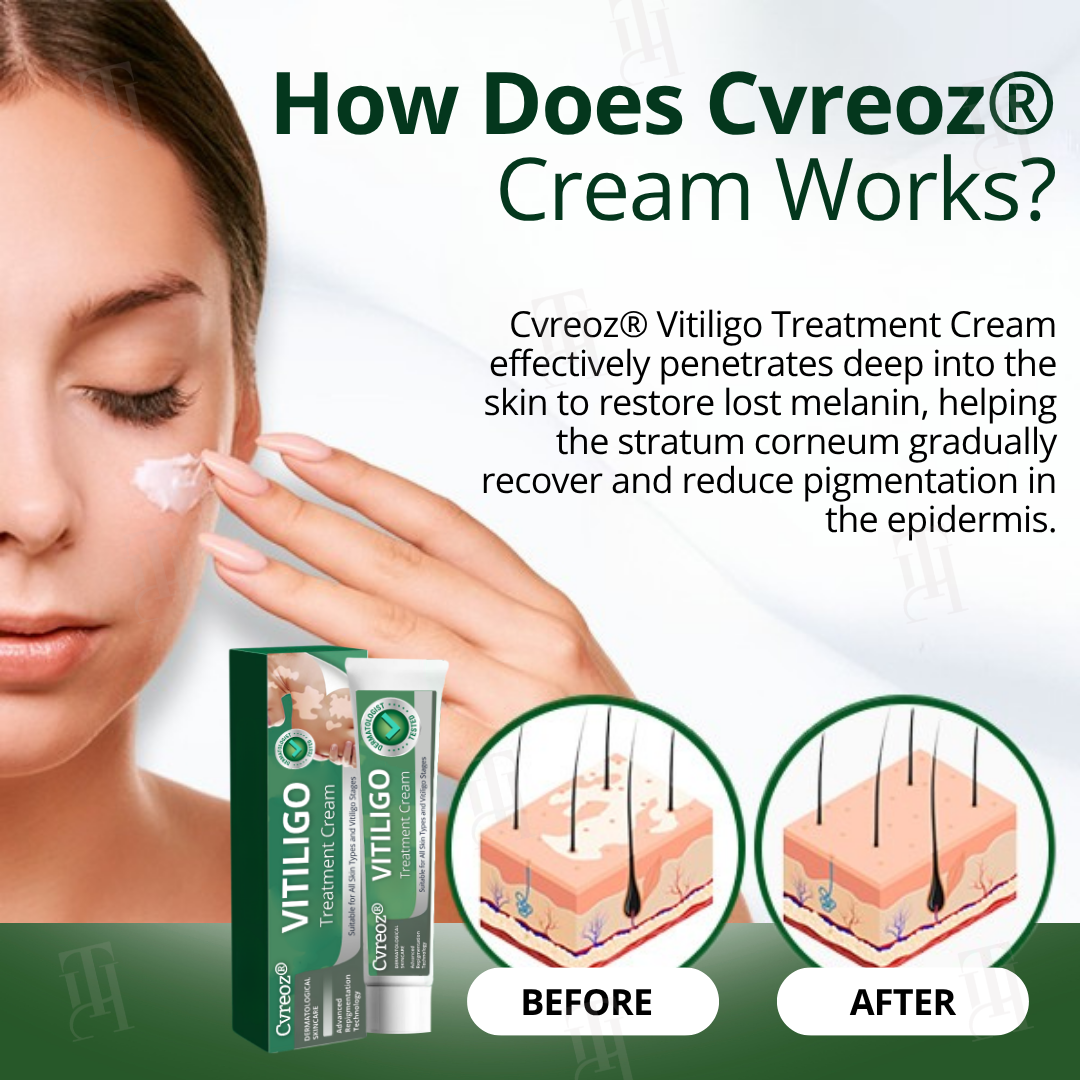 đ„Hot Sales - 60% OFFđ„CvreozÂź Vitiligo Treatment Cream