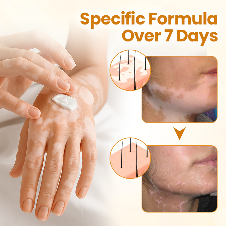 ⏰Last Day Promotion: 60% OFF🔥Cvreoz® VitiliGo Bee Toxin Cream