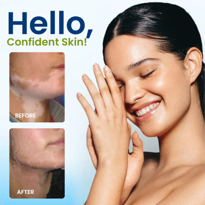 ⏰Limited Stock🔥Flash Sale 60% OFF🔥 Cvreoz® Vitiligo Treatment Spray