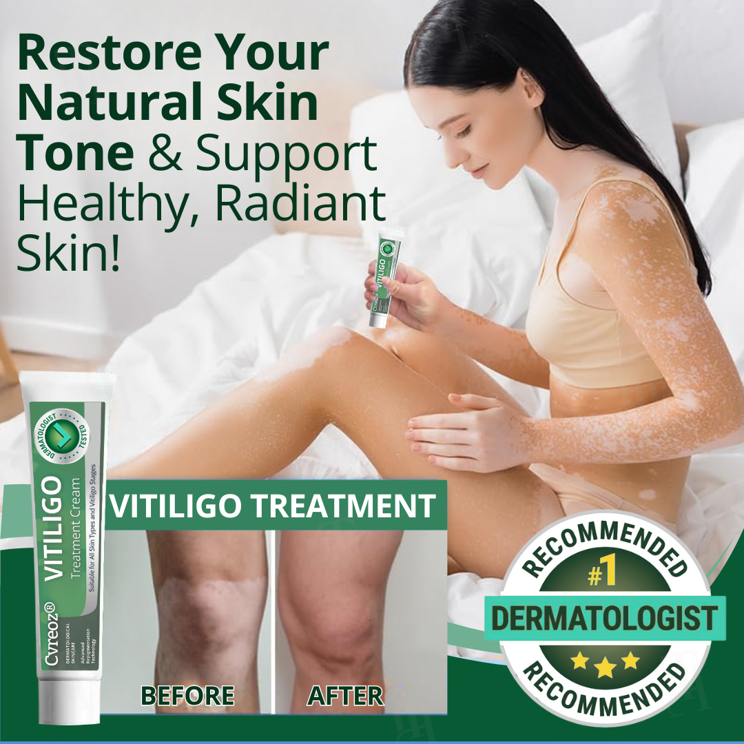 đ„Hot Sales - 60% OFFđ„CvreozÂź Vitiligo Treatment Cream