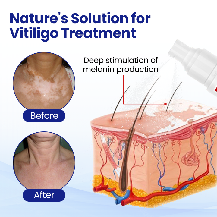⏰Last Day Promotion: 60% OFF🔥 Cvreoz® Herbal VitiCare Spray