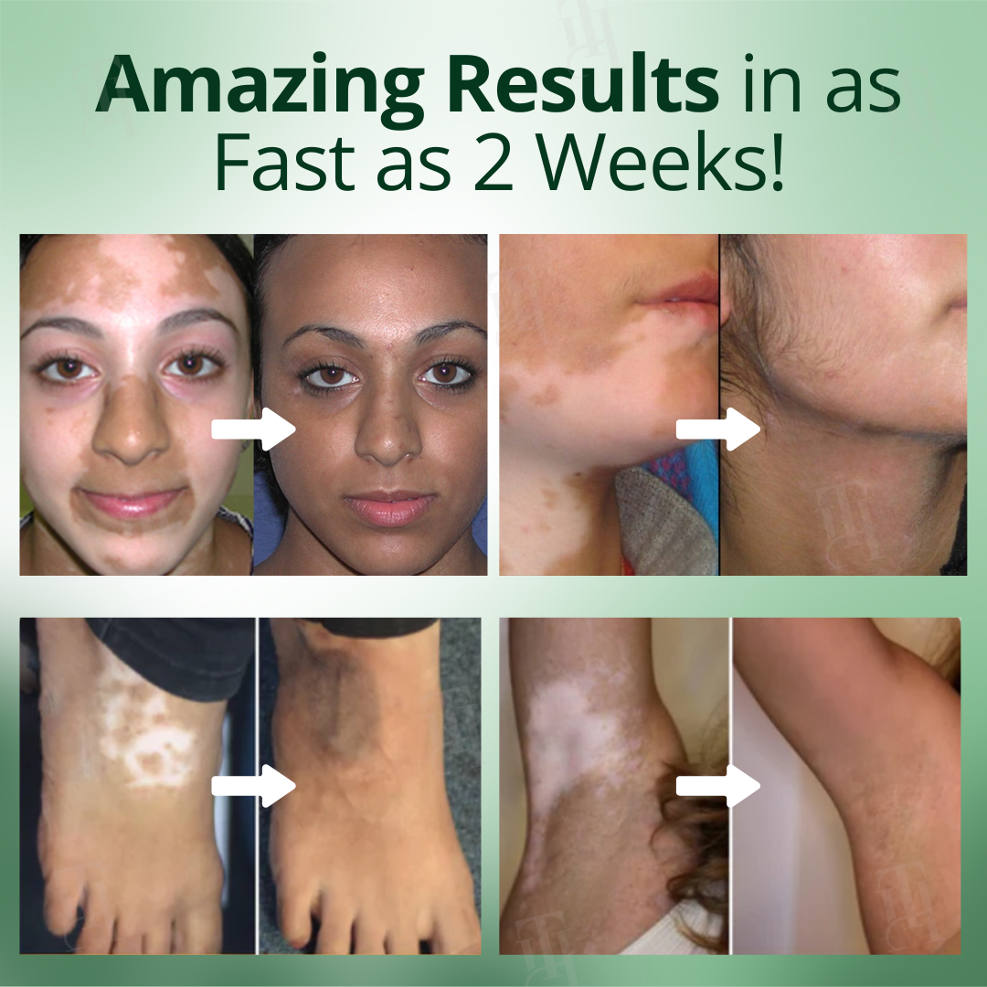 đ„Hot Sales - 60% OFFđ„CvreozÂź Vitiligo Treatment Cream