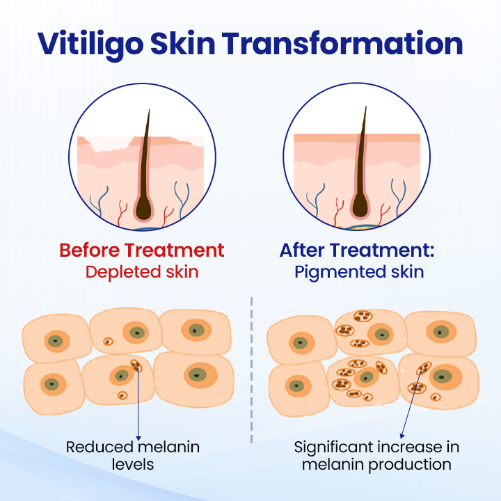 đ CVREOZÂŽ Vitiligo Herbal Spray â¤ď¸ SUMMER SALE 60% OFFâ¤ď¸âđĽ
