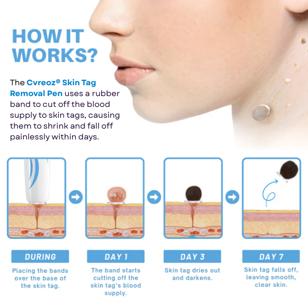 Cvreoz® Skin Tag Removal Pen