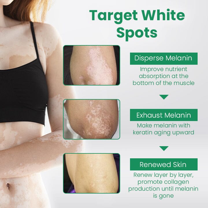 💛 LIMITED OFFER 60% OFF 💛 Cvreoz® VitiligoCare Revitalizing Elixir
