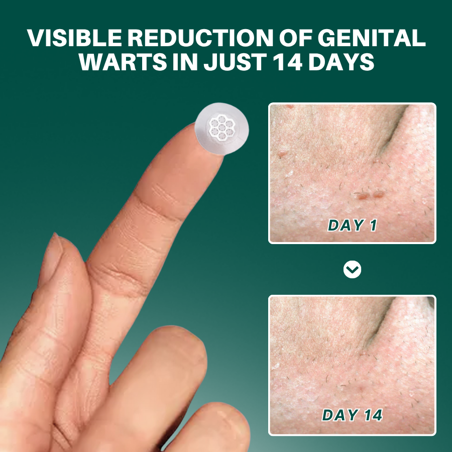 Cvreoz® Genital Wart Removal Patch – Now 60% OFF | Pain-Free, Clinically Proven Solution