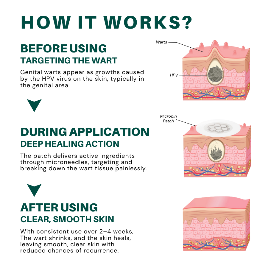 Cvreoz® Genital Wart Removal Patch – Now 60% OFF | Pain-Free, Clinically Proven Solution