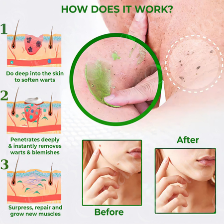 🔥HOT SALE: 60% OFF🔥Cvreoz® Natural Spot and Mole removal cream