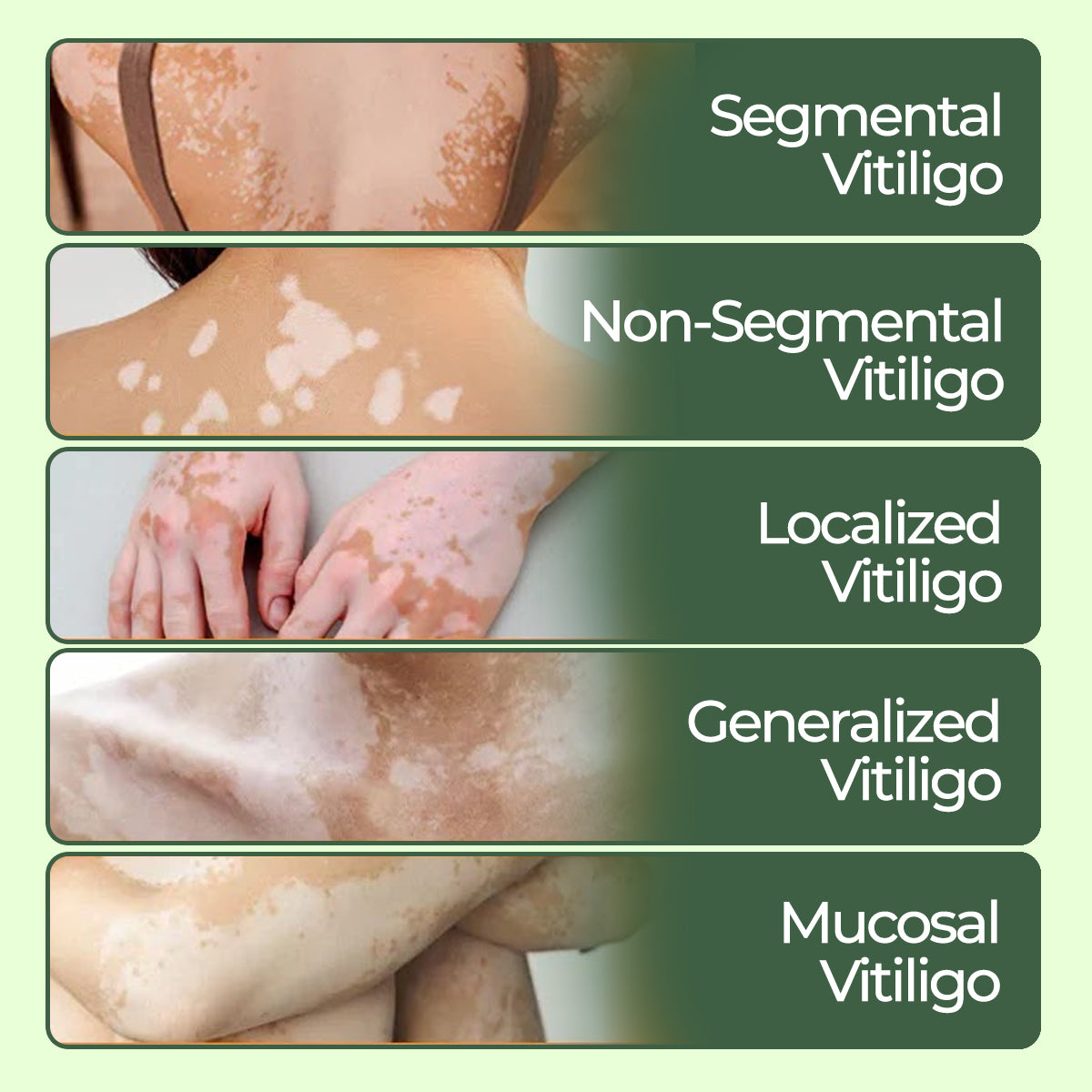 🔥LAST DEAL: 60% OFF🔥 Cvreoz® Vitiligo Treatment Ointment