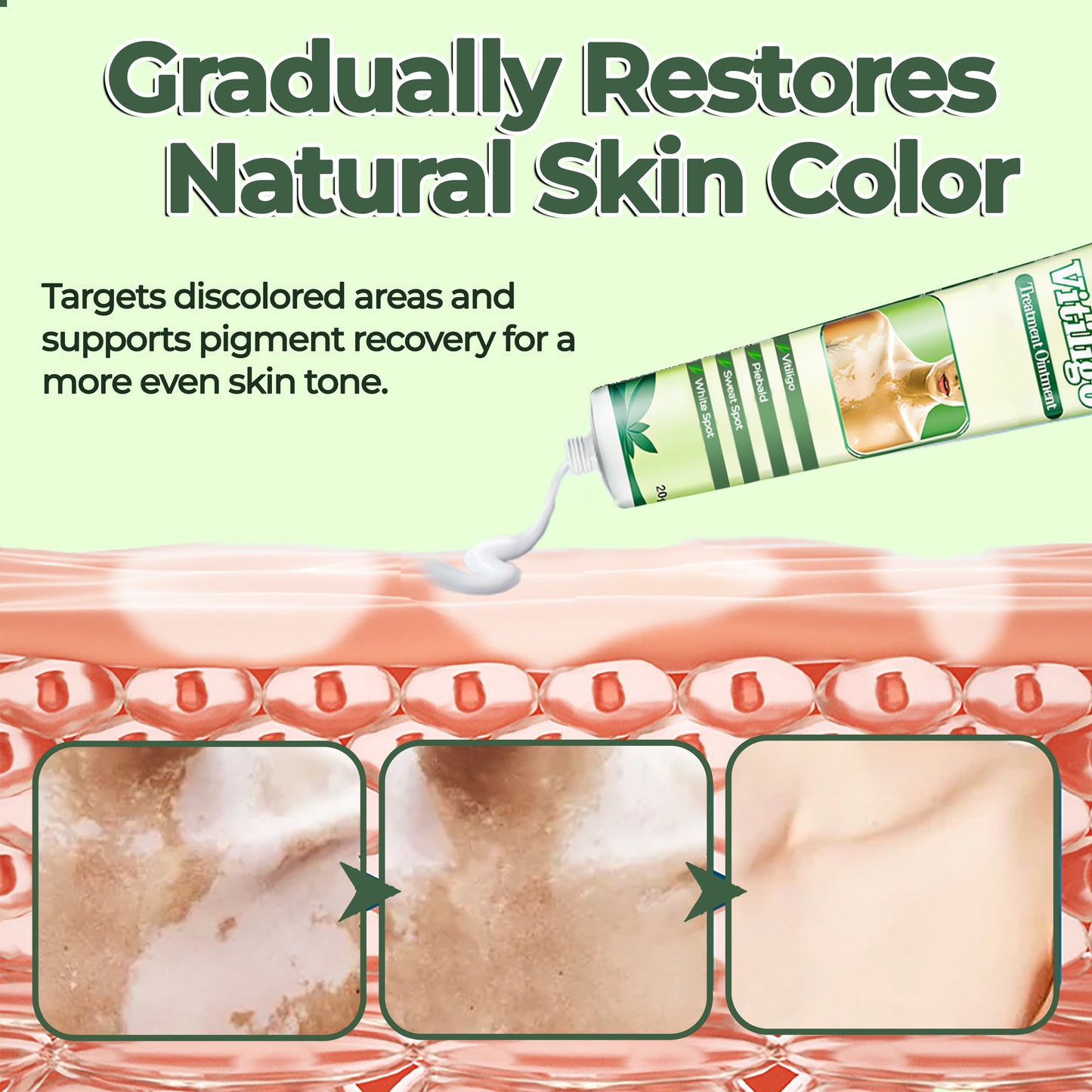 🔥LAST DEAL: 60% OFF🔥 Cvreoz® Vitiligo Treatment Ointment