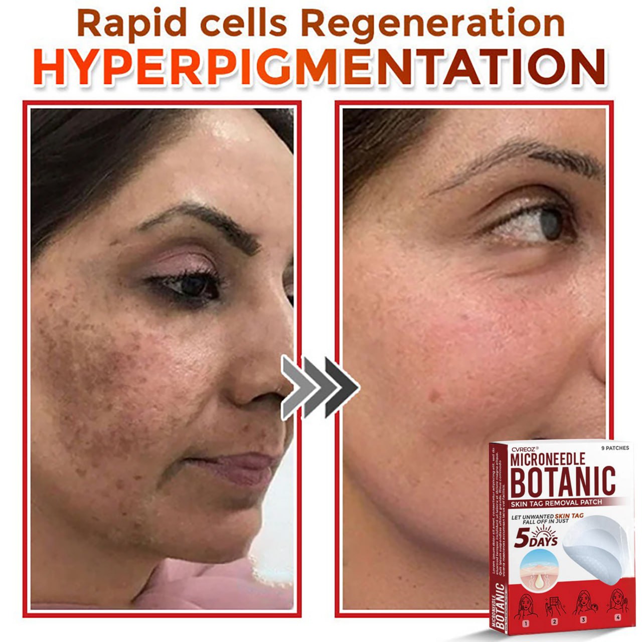 Cvreoz® MicroNeedle Botanic Skin Tag Removal Patch