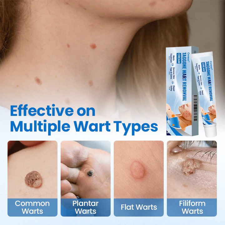 Cvreoz® TagGone Wart Removal Cream ✨🔥 HOT SALE 60% OFF🤩