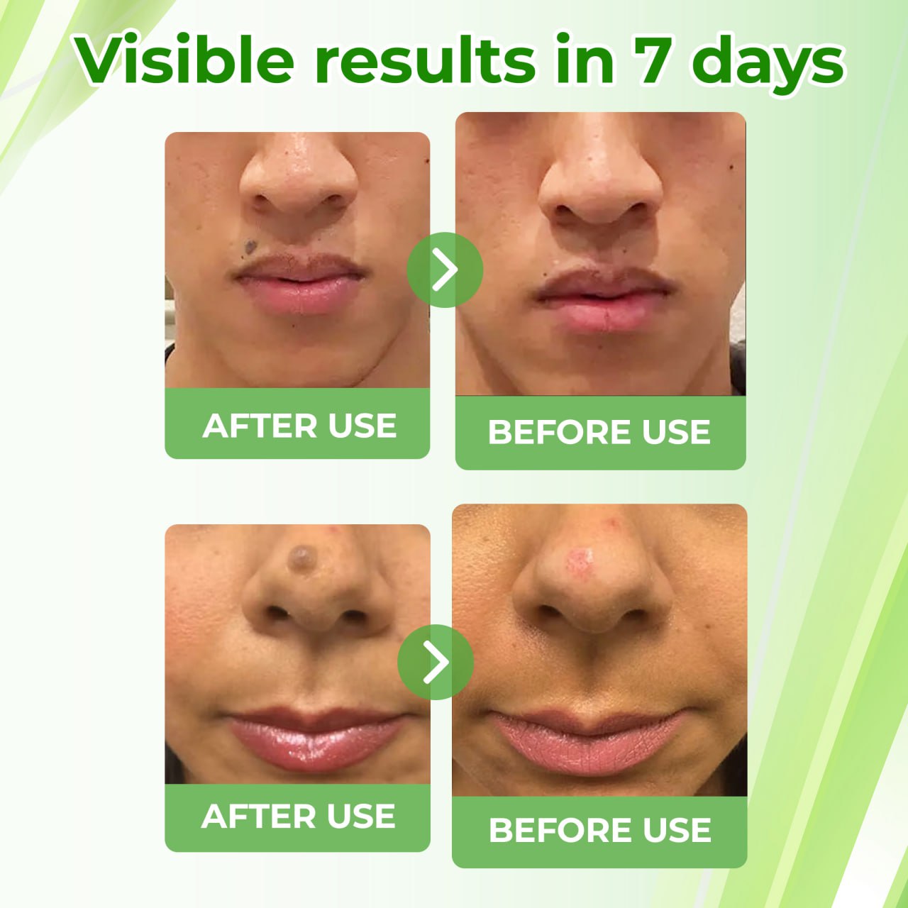🔥HOT SALE: 60% OFF🔥Cvreoz® Natural Spot and Mole removal cream