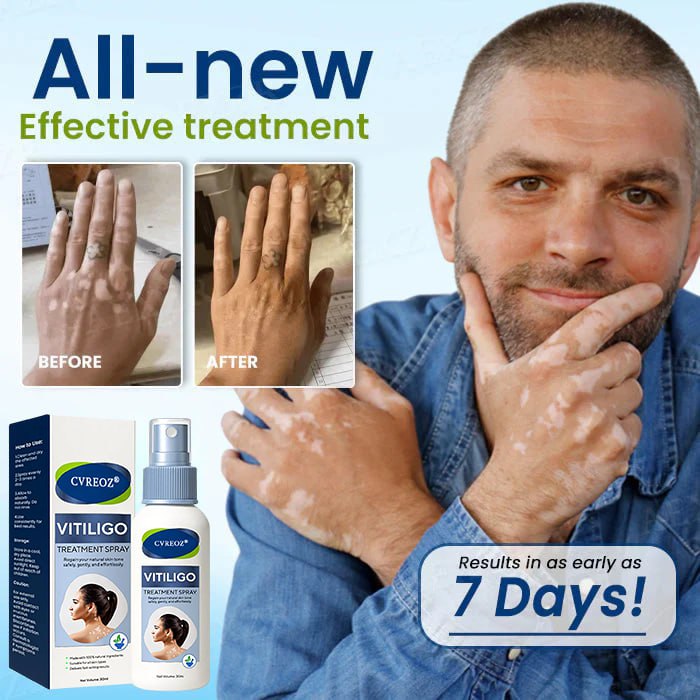 ⏰Limited Stock🔥Flash Sale 60% OFF🔥 Cvreoz® Vitiligo Treatment Spray