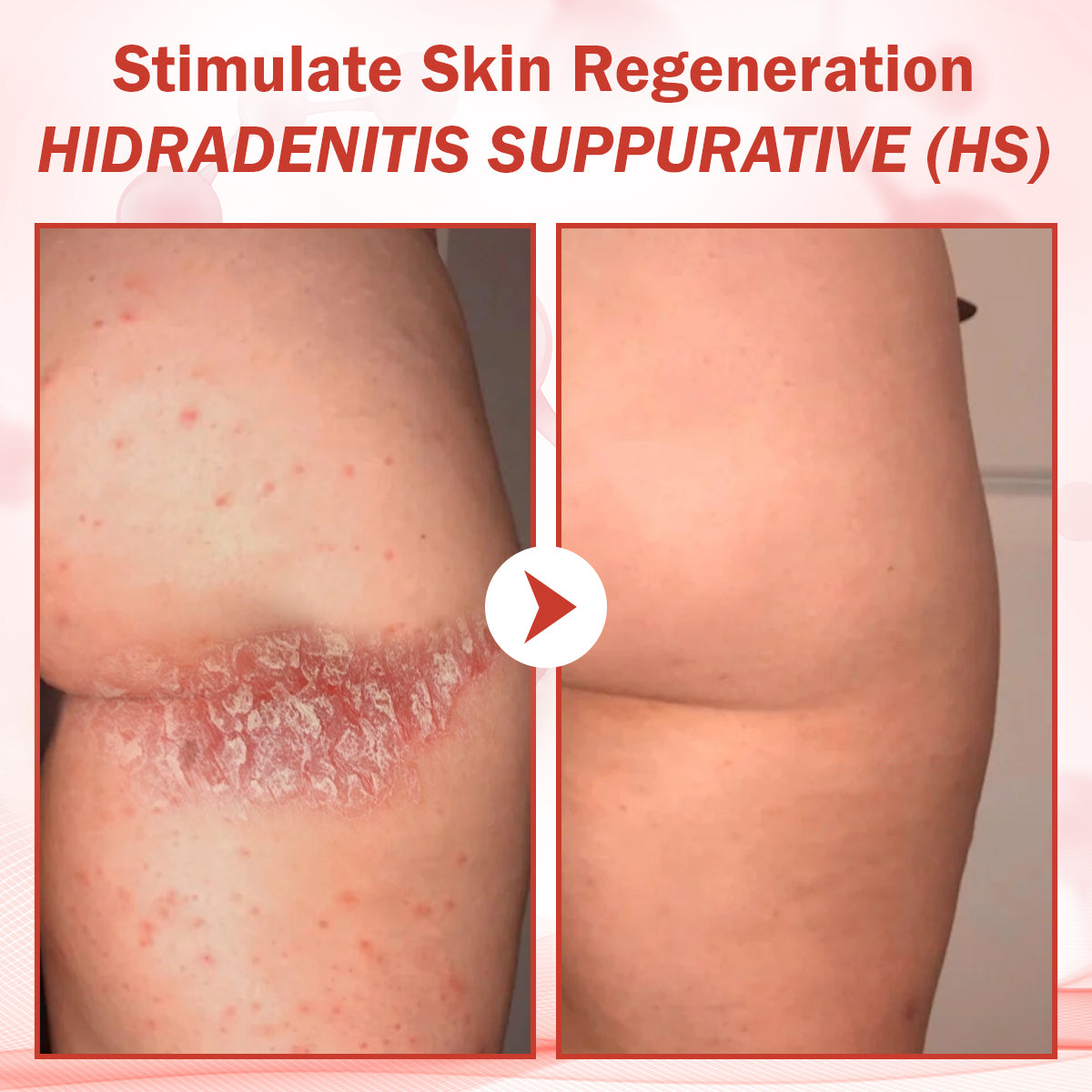 🔥HOT SALE: 60% OFF🔥Cvreoz® PureSkin Microneedle Botanic Patch