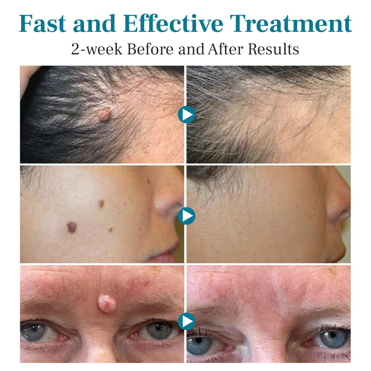 💫 Bikenda® Advanced LumeSkin Mole and Wart Removal Laser Pen 🔦 🔥 UP TO 60% OFF 🔥
