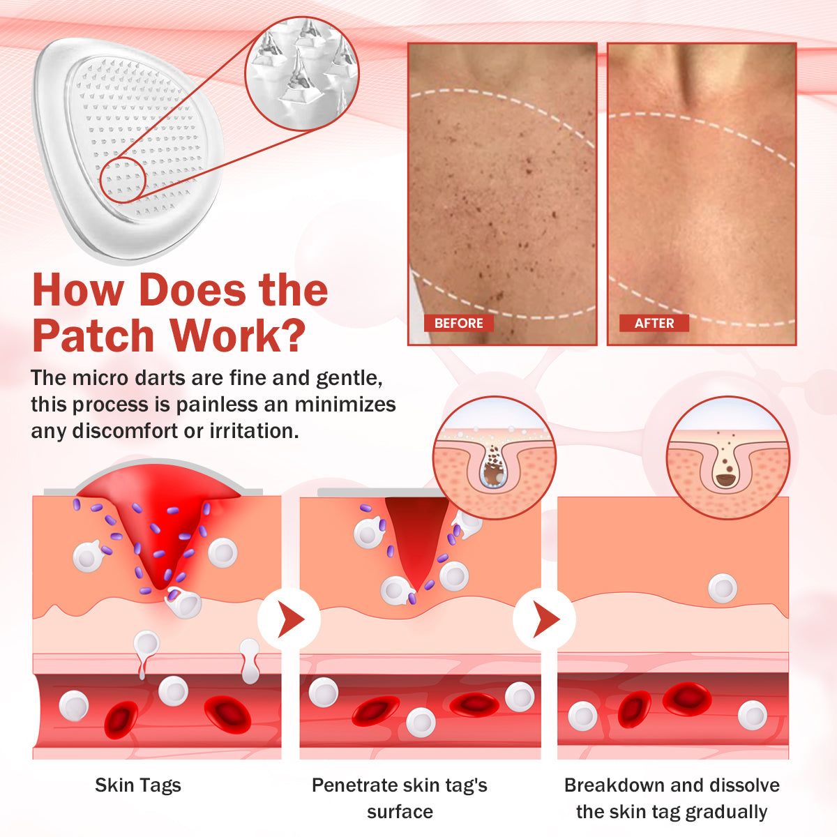 🔥HOT SALE: 60% OFF🔥Cvreoz® PureSkin Microneedle Botanic Patch
