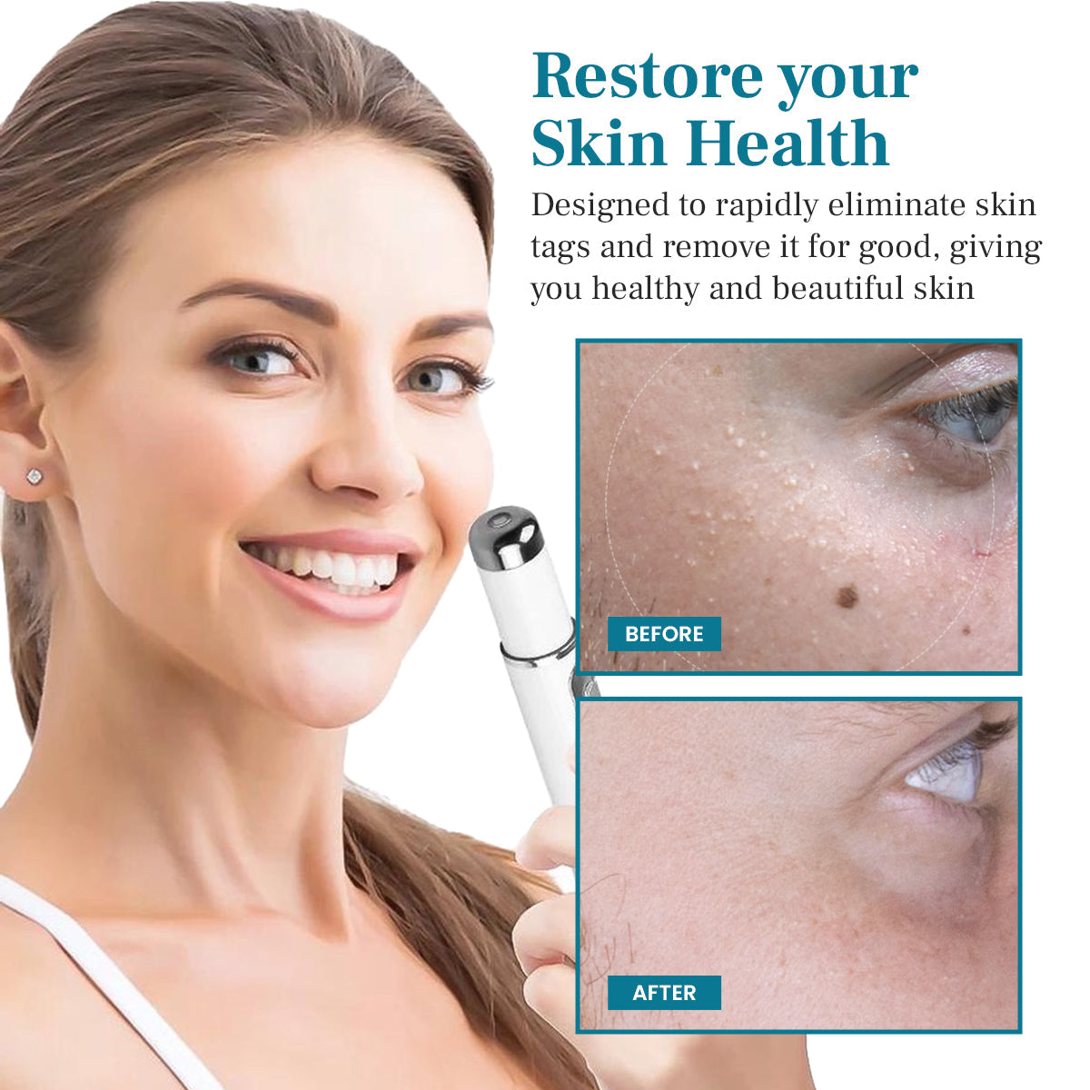 💫 Bikenda® Advanced LumeSkin Mole and Wart Removal Laser Pen 🔦 🔥 UP TO 60% OFF 🔥