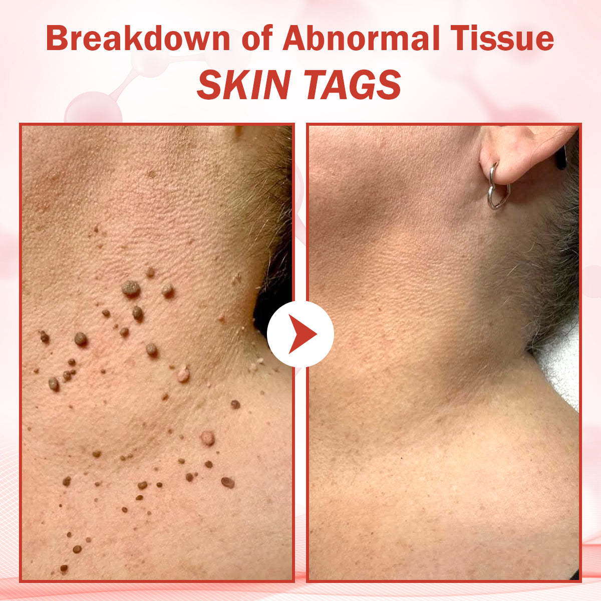 🔥HOT SALE: 60% OFF🔥Cvreoz® PureSkin Microneedle Botanic Patch