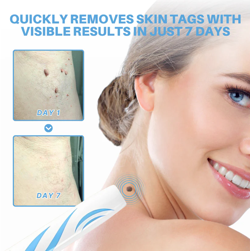 Cvreoz® Skin Tag Removal Pen