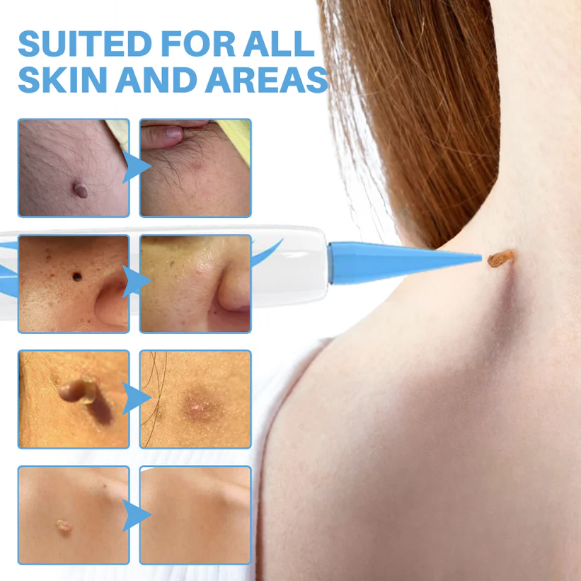 Cvreoz® Skin Tag Removal Pen