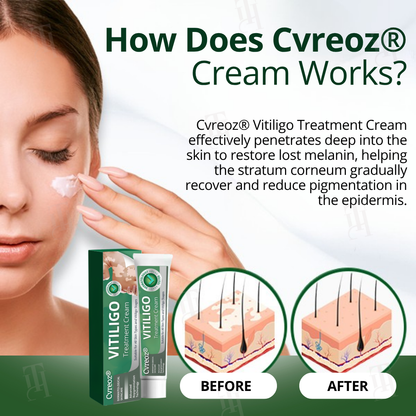 🔥Hot Sales - 60% OFF🔥Cvreoz® Vitiligo Treatment Cream