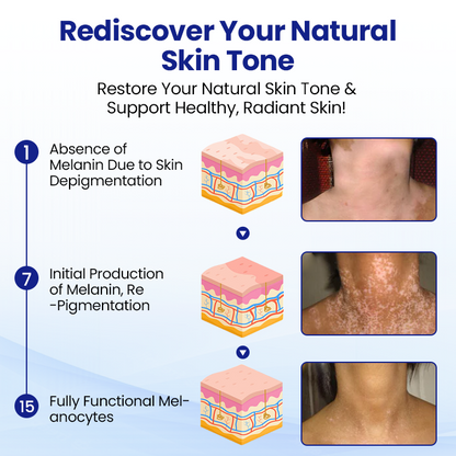 💙 CVREOZ® Vitiligo Herbal Spray ❤️ SUMMER SALE 60% OFF❤️‍🔥