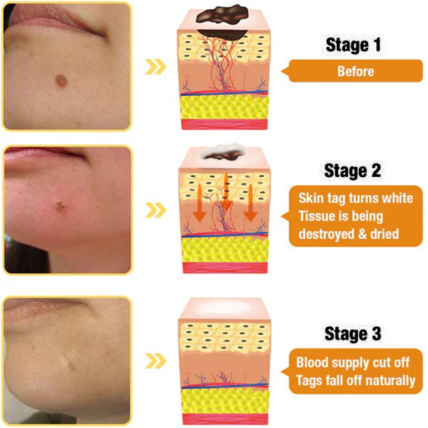 🎉SPECIAL OFFER: 60% OFF This Week Only!🔥 Cvreoz® BeePure Skin Tag Treatment Spray