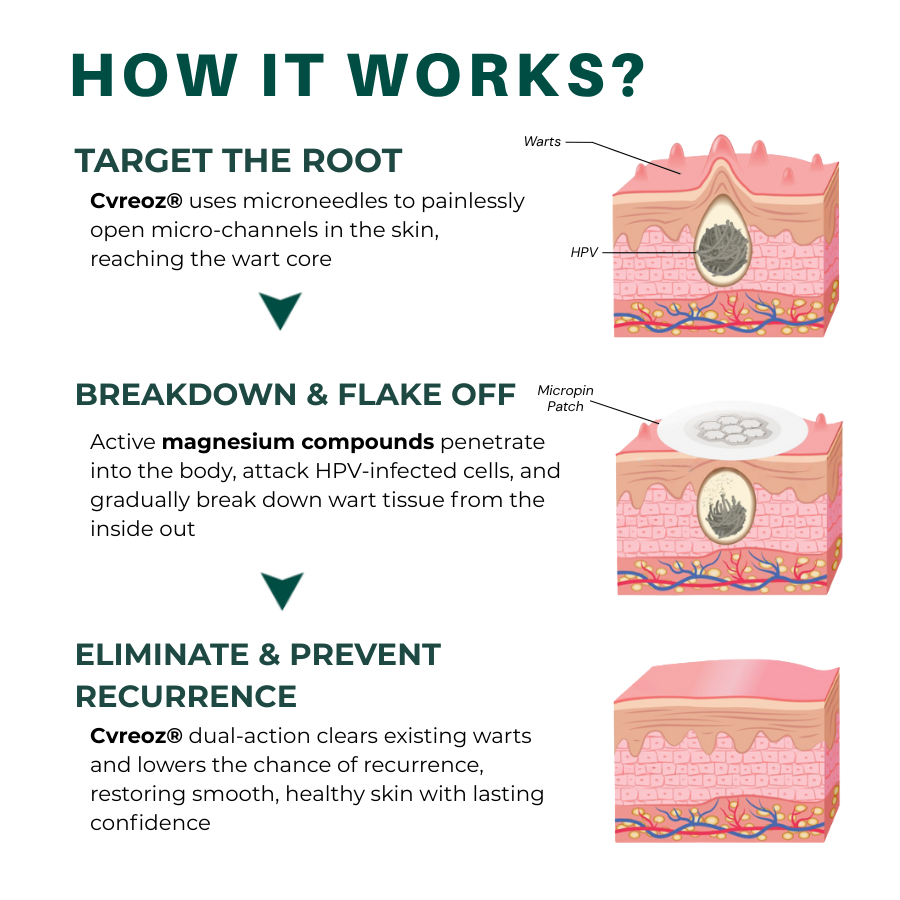 Cvreoz® Genital Wart Removal Patch – Now 60% OFF | Pain-Free, Clinically Proven Solution