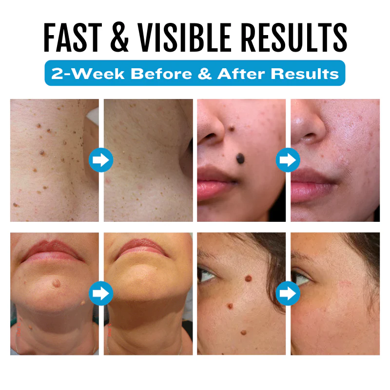 Bikenda® SpotlessDerm Mole and Wart Laser Pen