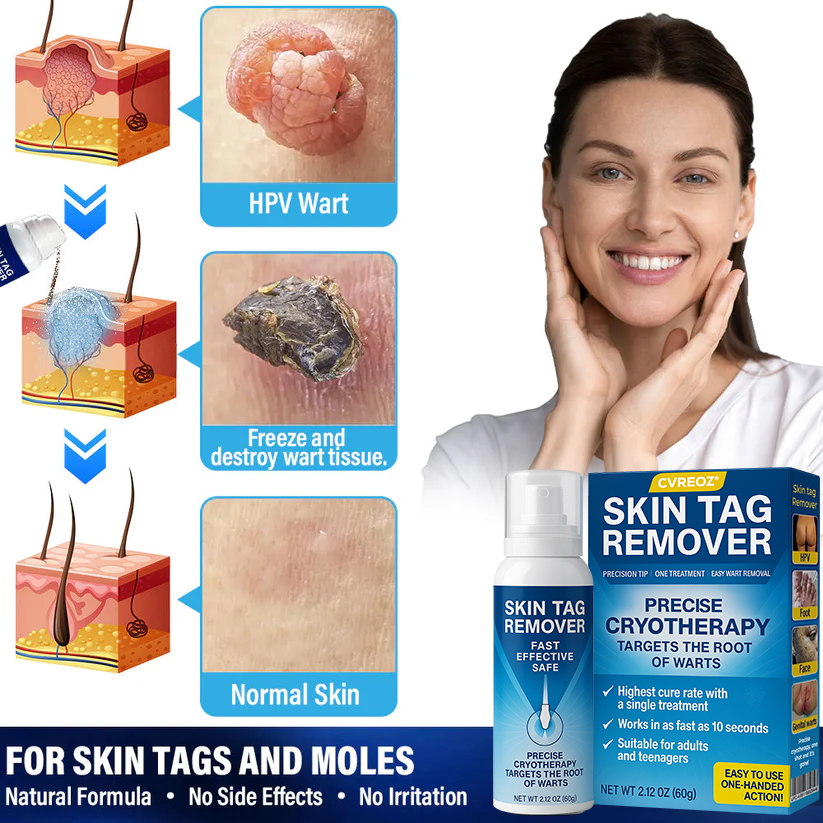 🔥HOT SALE 50% OFF💥 Cvreoz® TagRecede Cryo Treatment Spray