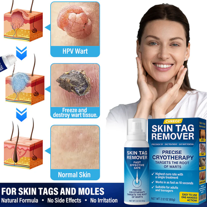 🔥HOT SALE 50% OFF💥 Cvreoz® TagRecede Cryo Treatment Spray