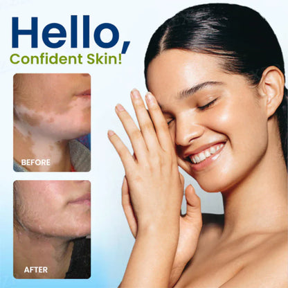 ⏰Limited Stock🔥Flash Sale 60% OFF🔥 Cvreoz® Vitiligo Treatment Spray