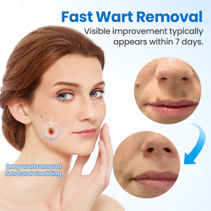 Cvreoz® TagGone Wart Removal Cream ✨🔥 HOT SALE 60% OFF🤩