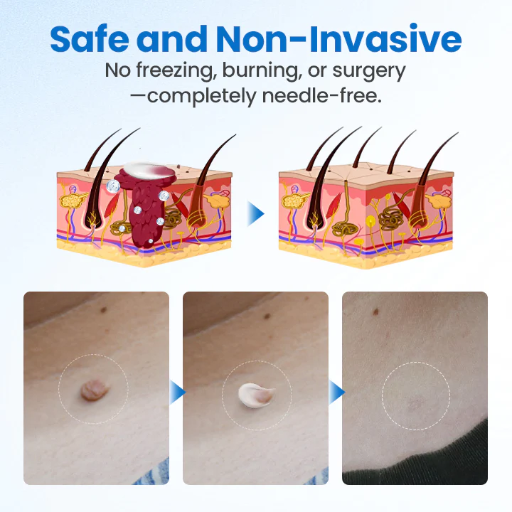 Cvreoz® TagGone Wart Removal Cream ✨🔥 HOT SALE 60% OFF🤩