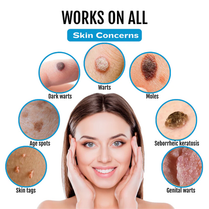 Bikenda® SpotlessDerm Mole and Wart Laser Pen