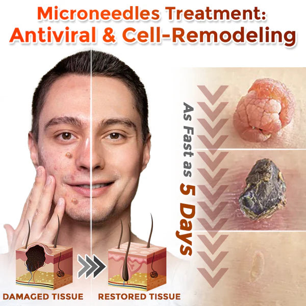 🔥 Last Day: 60% OFF ⏰ CVREOZ® Microneedle Botanic Skin Tag Removal Patch