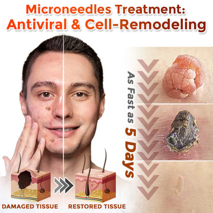 🔥 Last Day: 60% OFF ⏰ CVREOZ® Microneedle Botanic Skin Tag Removal Patch