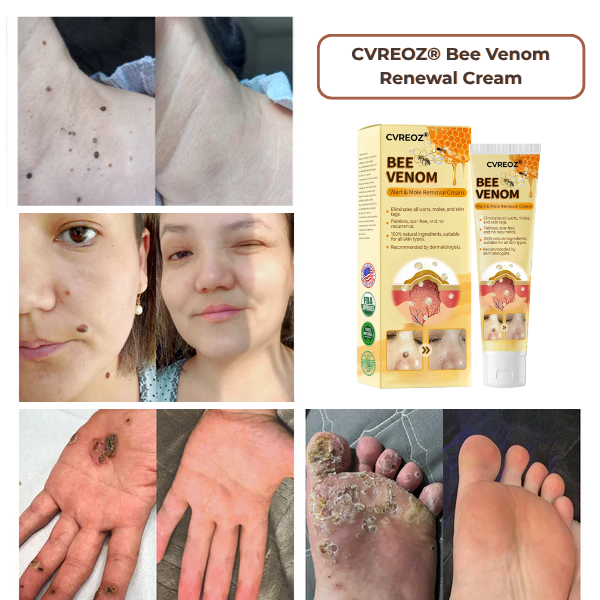🎉SPECIAL OFFER: 60% OFF This Week Only!🔥CVREOZ® Skin Tag Bee Venom Treatment Cream
