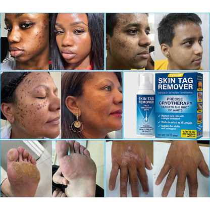 🔥HOT SALE 50% OFF💥 Cvreoz® TagRecede Cryo Treatment Spray