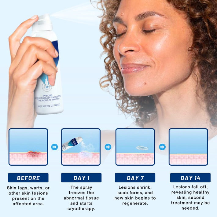 🔥HOT SALE 50% OFF💥 Cvreoz® TagRecede Cryo Treatment Spray