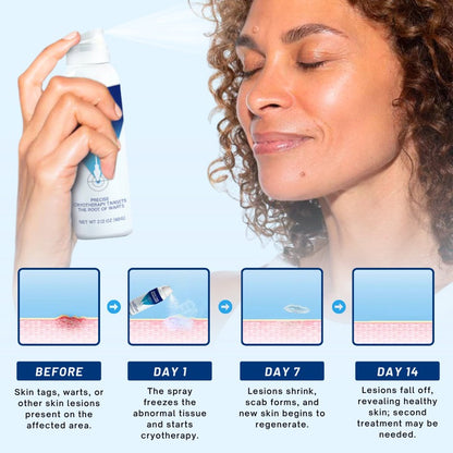 🔥HOT SALE 50% OFF💥 Cvreoz® TagRecede Cryo Treatment Spray