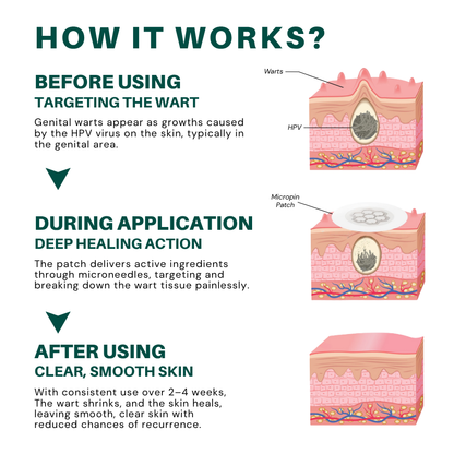 Cvreoz® Genital Wart Removal Patch – Now 60% OFF | Pain-Free, Clinically Proven Solution