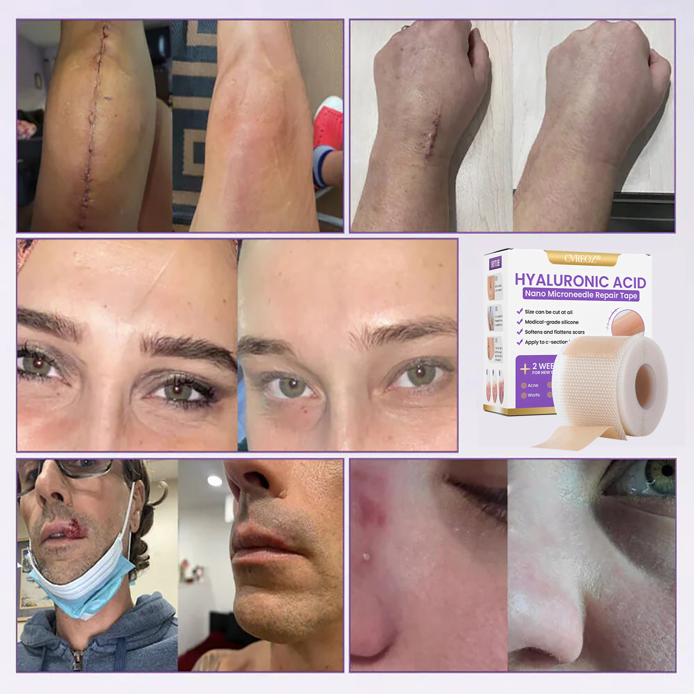 CVREOZ® Hyaluronic Acid Nano Microneedle Repair Tape⏰Limited Offer: Up to 60% OFF🔥