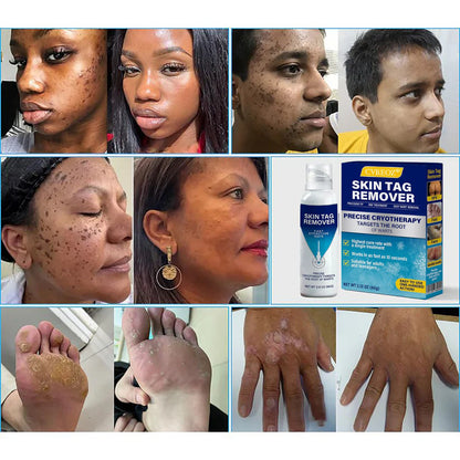 CVREOZ® TagRecede Cryo Treatment Spray🔥Last Deal: 60% Off🔥