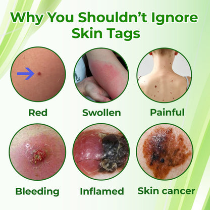 🔥HOT SALE: 60% OFF🔥Cvreoz® Natural Spot and Mole Removal Cream