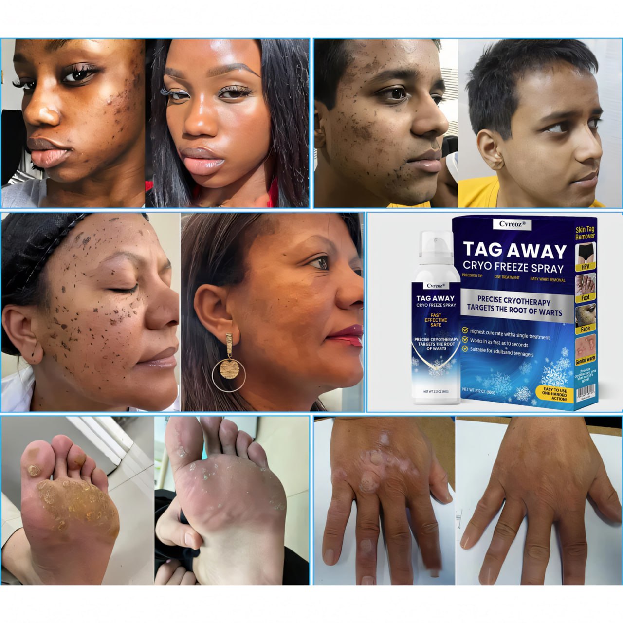 Cvreoz® TagAway Cryo Freeze Spray