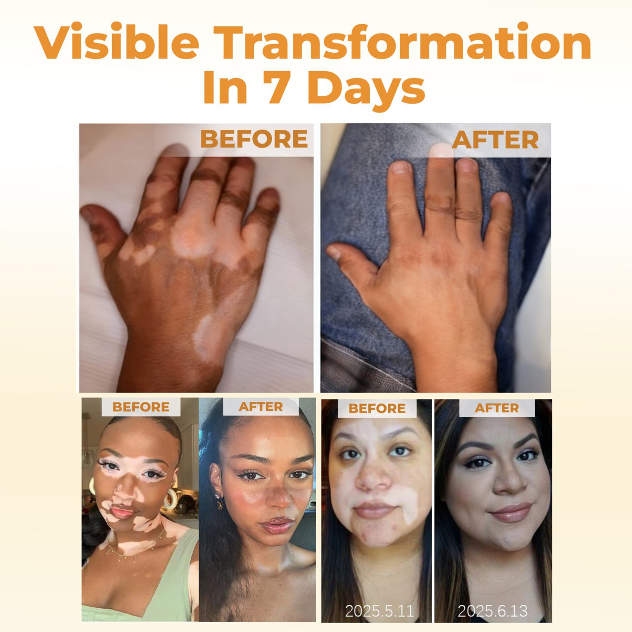 Cvreoz® VitiGone Rapid Spray — 2 Week Repigmentation with OTDS