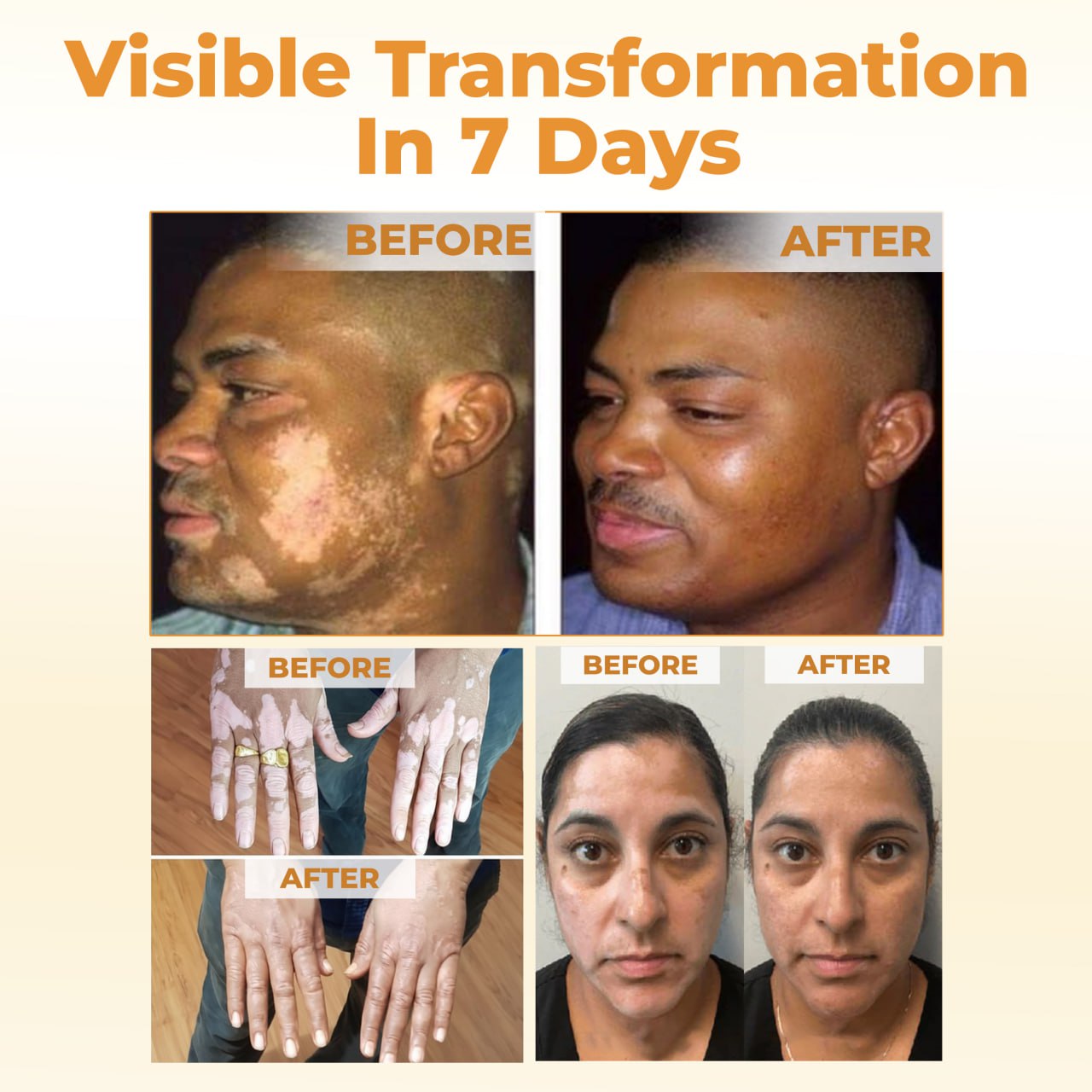 Cvreoz® VitiGone Rapid Spray — 2 Week Repigmentation with OTDS